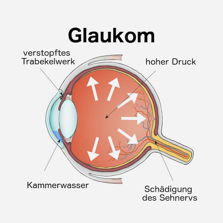 nadh Glaukom nadh Glaukom